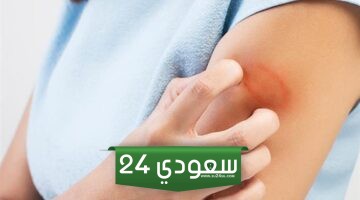 أفضل مرهم لعلاج القوباء من الصيدلية