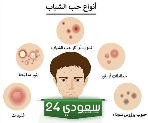 أماكن الحبوب في الوجه