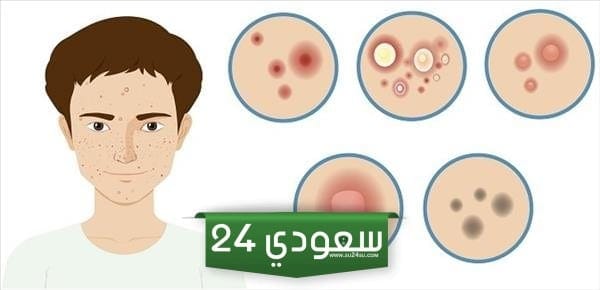 أماكن الحبوب في الوجه