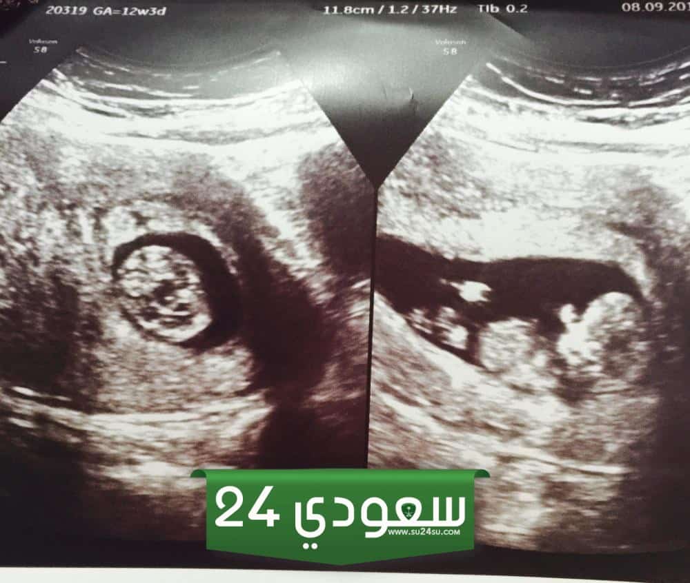جمجمة الجنين الذكر