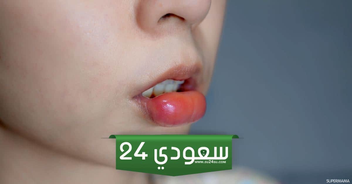 علاج تورم الشفاه بعد البنج