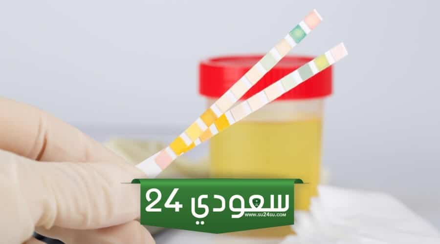 لون البول الأبيض وطرق علاجه