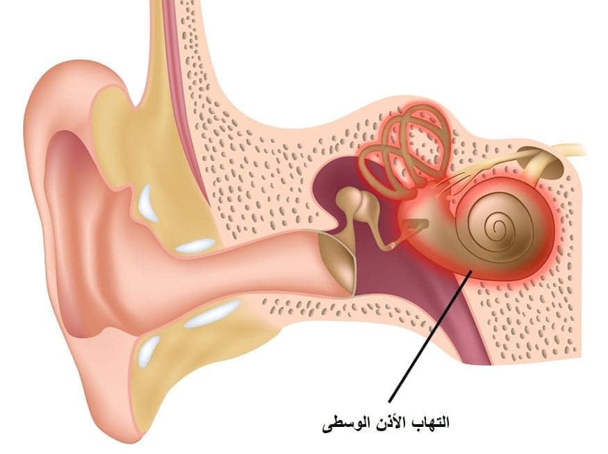 التهاب الأذن الوسطى | مقال عربي