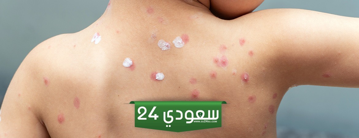 ما هو وباء الجدري المائي
