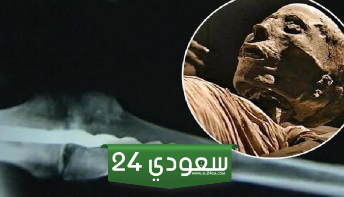 مسمار معدني في الركبة