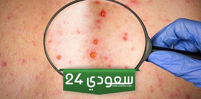 وزارة التربية تتخذ قرارات عاجلة لمكافحة وباء الجدري المائي في مصر