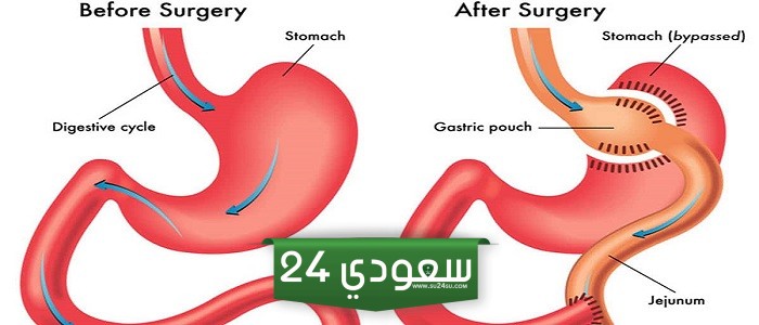 عملية تحويل مسار الأمعاء والاثنى عشر ..” أقوال الأطباء ”