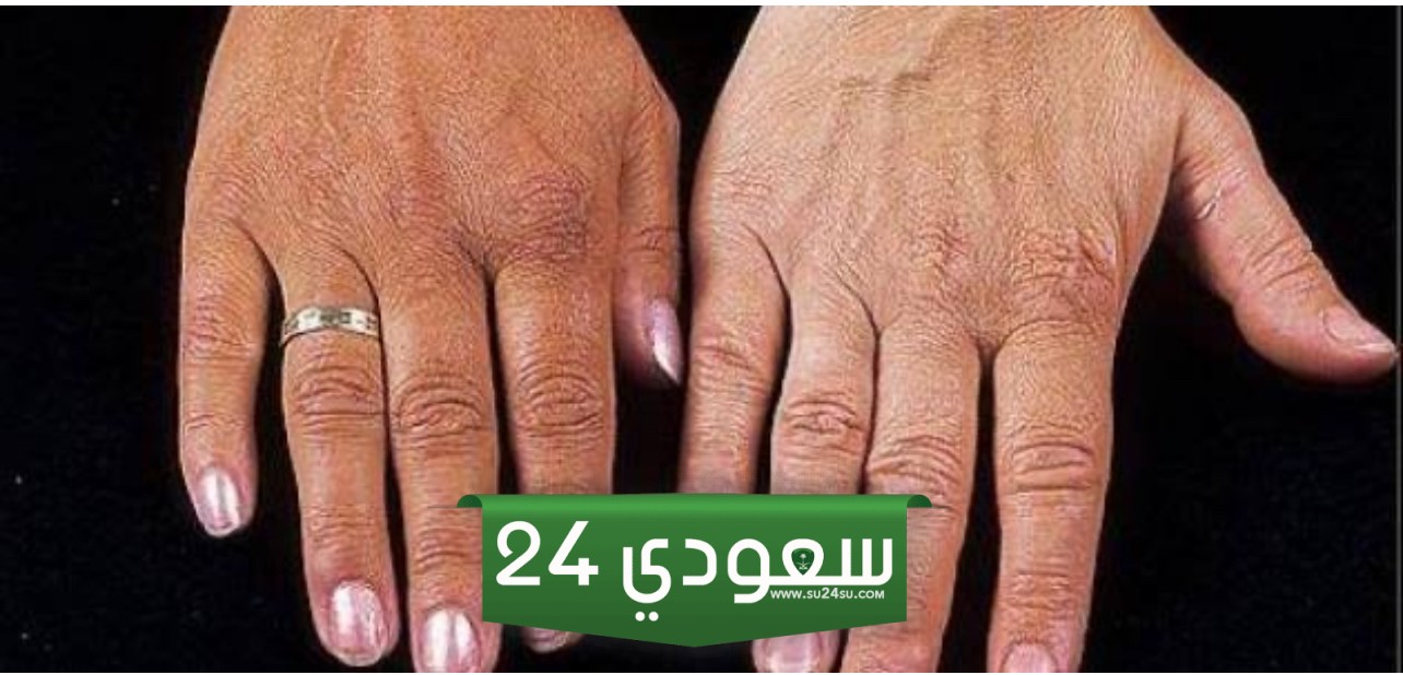 أسباب صادمة تؤدي إلى تغير لون الجلد