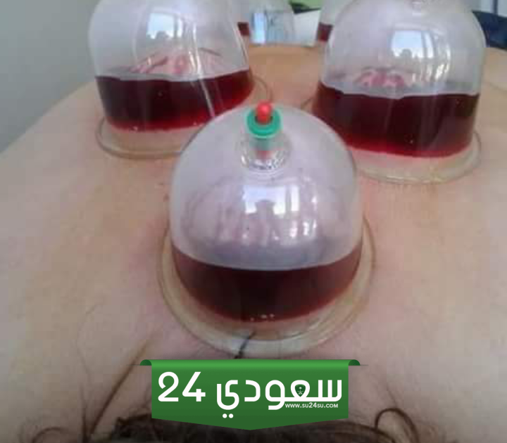 أيام الحجامة لشهر أكتوبر
