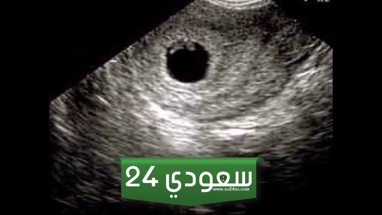 تأخر ظهور الجنين في الكيس