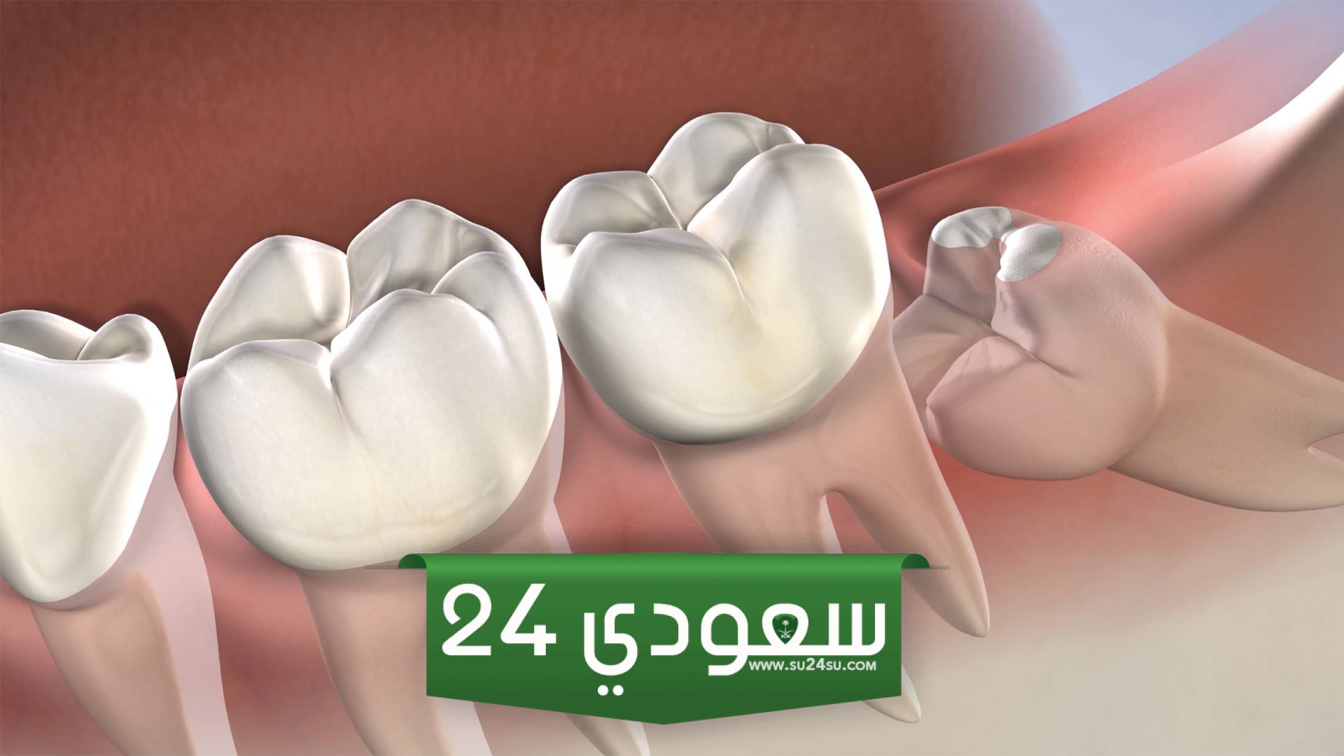 تفسير حلم الضرس المثقوب