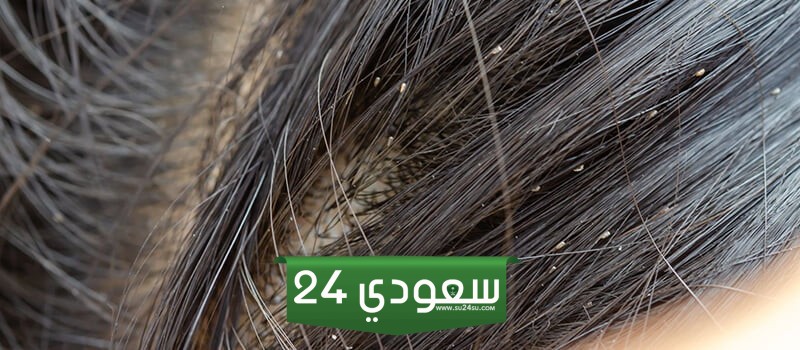 تفسير رؤية القمل في شعر بنتي