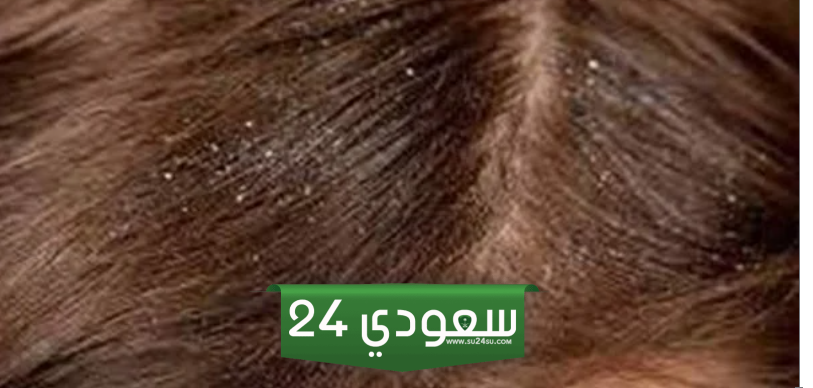 تفسير حلم رؤية القمل في شعر شخص آخر