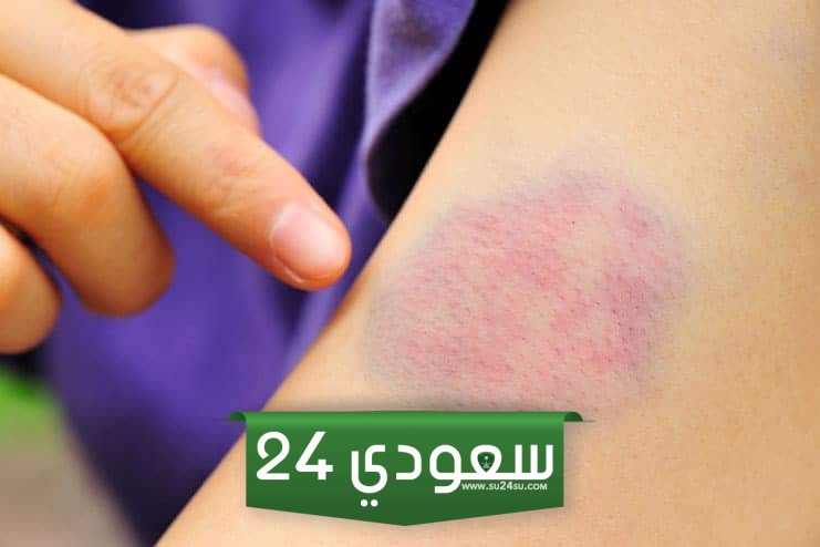 تفسير رؤية كدمات حمراء وزرقاء في المنام