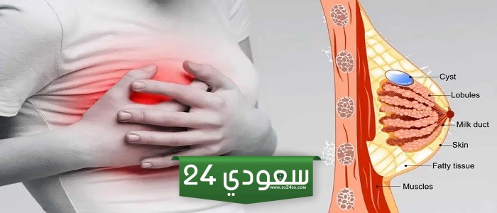 تجربتي مع تكيسات الثدي وأضرارها وكيف تخلصت منها
