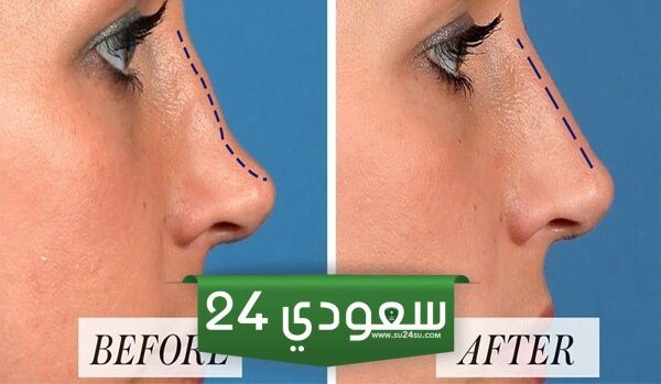 تجربتي مع عملية تجميل الأنف بالليزر