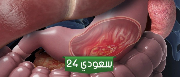 حالات شفيت من سرطان المعدة في فترة قصيرة
