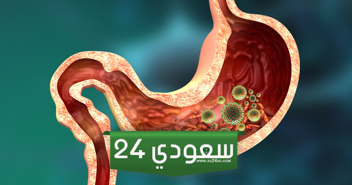 هل تعاني من ألم في هذا المكان؟.. قد تكون جرثومة المعدة هي السبب