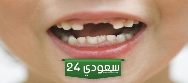سقوط الأسنان في المنام للمتزوجة
