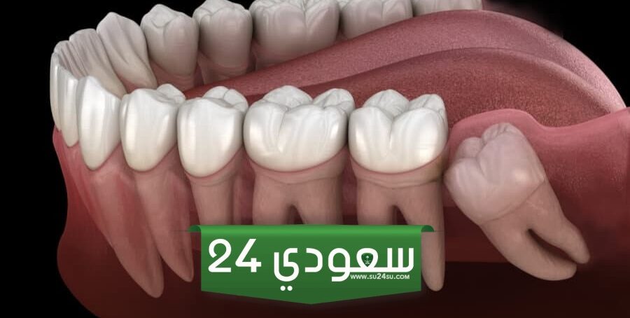 تجربتي مع خلع ضرس العقل وهل تشعر بالألم؟