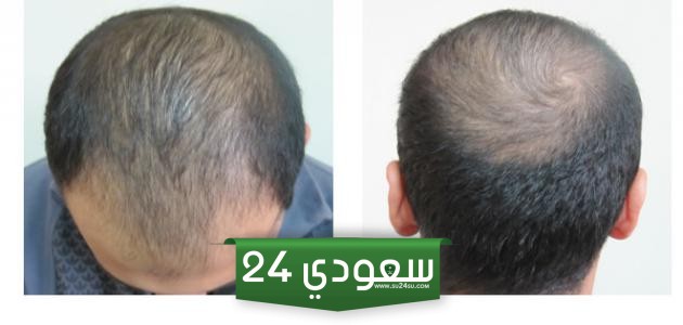 تجربتي مع زراعة الشعر في الرياض وأفضل طبيب