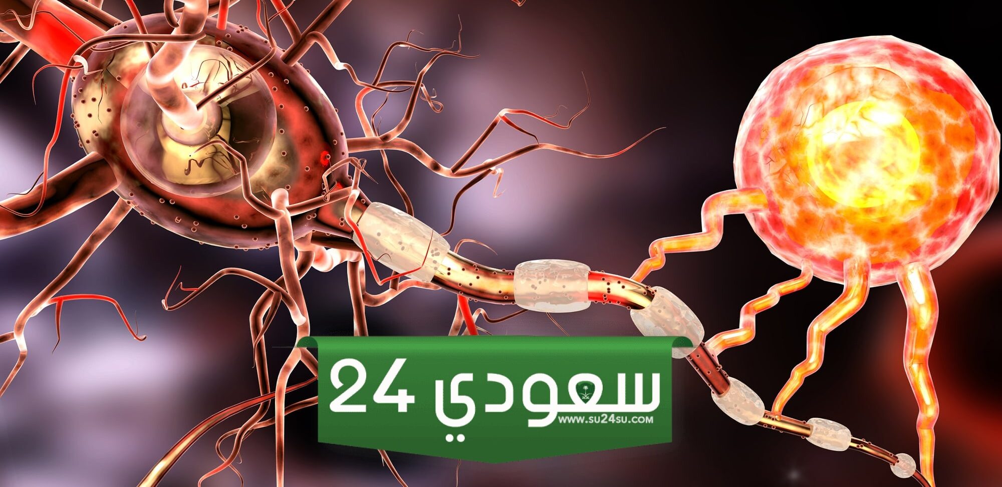 هل مرض ms خطير؟! التصلب المتعدد