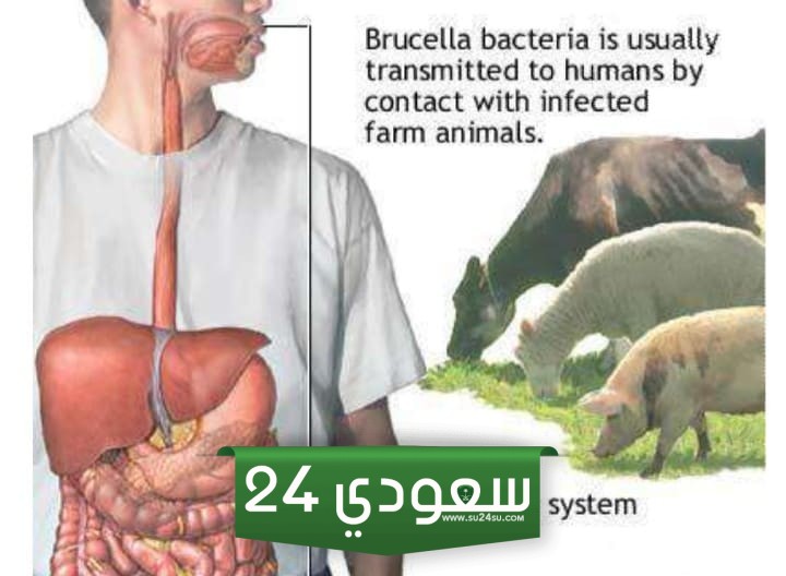 الحمى المالطية الاعراض والتفاصيل
